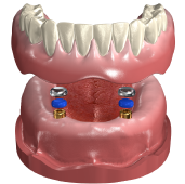 ロケーターアタッチメントシステム|株式会社インプラテックス