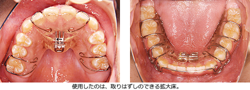 拡大床による矯正歯科治療のトラブル事例②｜Vol.18 拡大床を使った