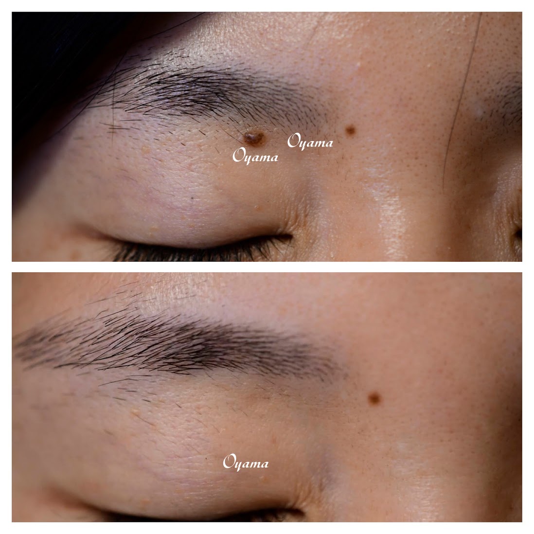 目の周りのほくろ除去(目の上・目の下)｜大山皮膚科｜足立区 五反野駅1