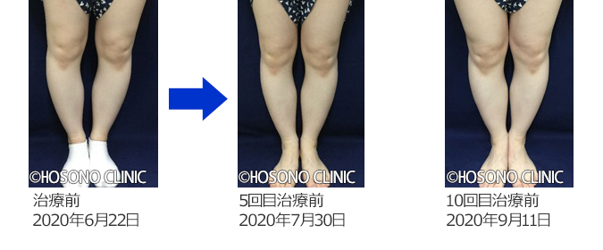 O脚・X脚治療プログラム-痛みの原因治療専門外来【細野クリニック